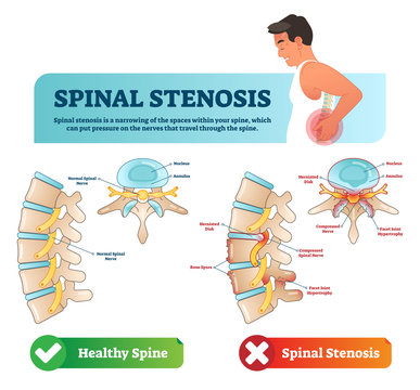 Spinal stenosis vector illustration. Labeled medical scheme with explanation. Diagram with normal spinal nerve, nucleus, annulus, bone spurs and compressed spinal nerve.