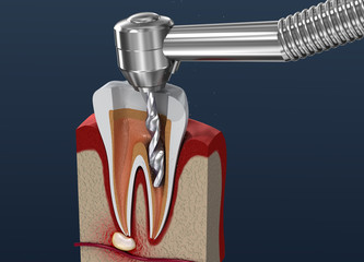 Root canal treatment process. 3D illustration