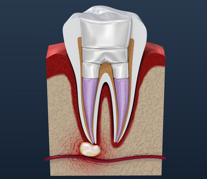 Dental fillings procedure diagramm . 3D illustration