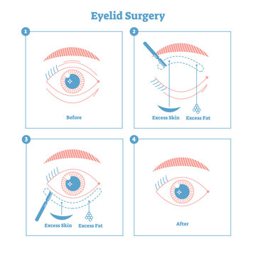 Eyelid surgery procedure scheme illustration. Excess skin and fat removal plastic surgery. Women fashion and beauty informative material with modern simple line style design.