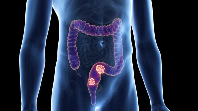 medically accurate 3d animation of colon cancer