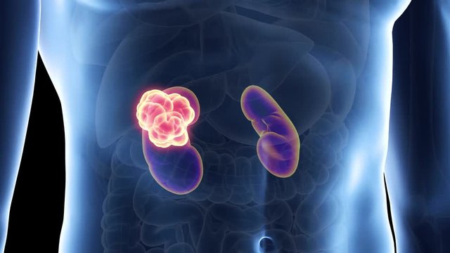 medically accurate 3d animation of kidney cancer
