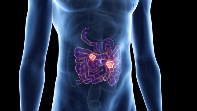 medically accurate 3d animation of bowel cancer