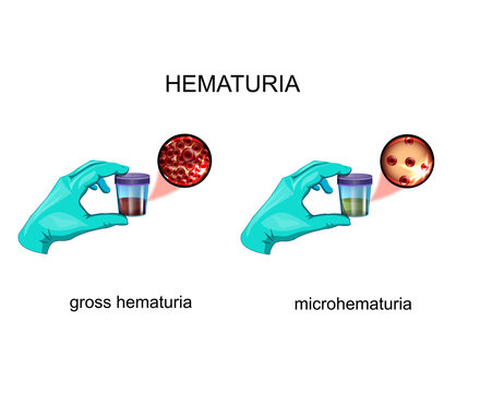 hematuria. blood in urine
