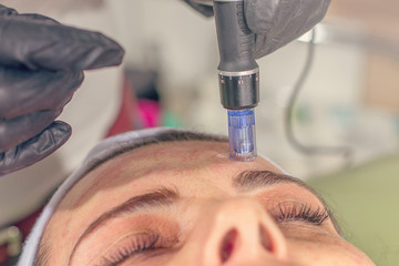 Needle mesotherapy treatment on a woman face. - obrazy, fototapety, plakaty