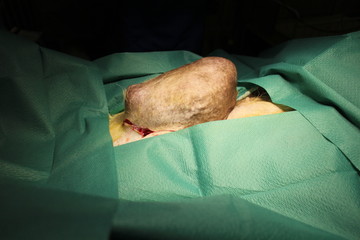 Big tumor on mammary gland by german shepherd dog 