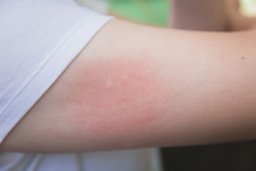 irritation skin allergy by mosquitoes insect bite or sting red infection from itching tickle or...