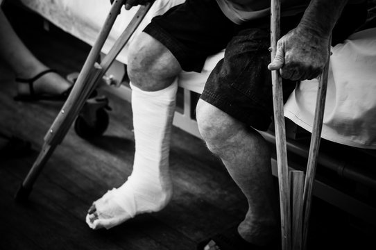 An old man with a plaster on his broken leg sitting on a bed in hospital holding crutches. Concept of injury. Dramatic black and white