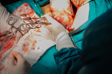 Hysterectomy surgery.