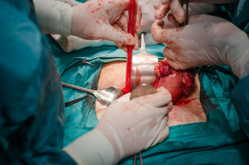 Hysterectomy surgery.