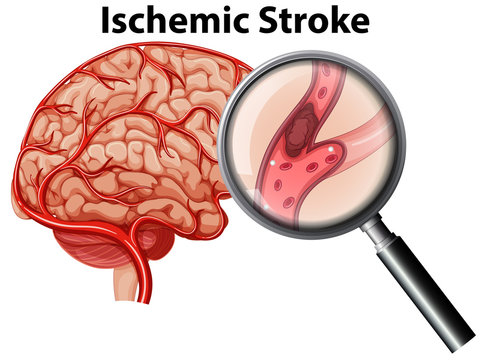 Magnified Ischemic stroke concept