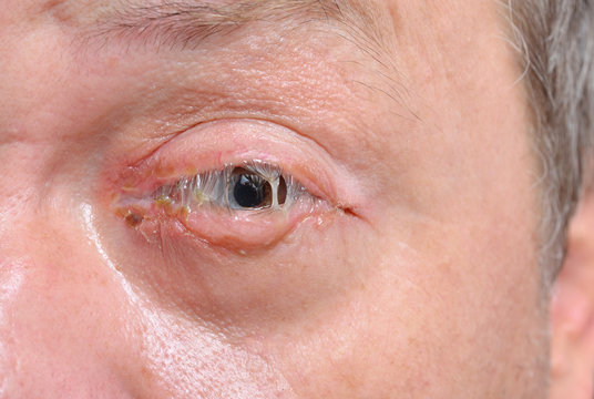An eye with bacterial purulence conjunctivitis, also known as pink eye