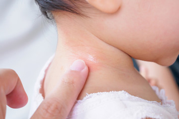 mother applying antiallergic cream at baby neck with skin rash and allergy with red spot cause by mosquito bite