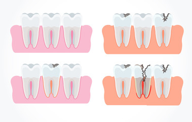 Stages of tooth decay with caries. Dentistry and oral care. Flat vector cartoon illustration. Objects isolated on white background.