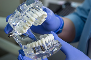 The dentist with blue gloves is holding the model of the jaw