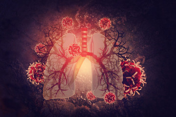 Virus and bacteria infected the Human lungs. lung disease - obrazy, fototapety, plakaty