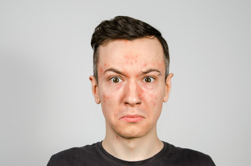 Obraz premium Portrait of young guy with allergy, with redness face