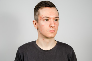 Fototapeta premium Portrait of young guy with allergy, with redness face