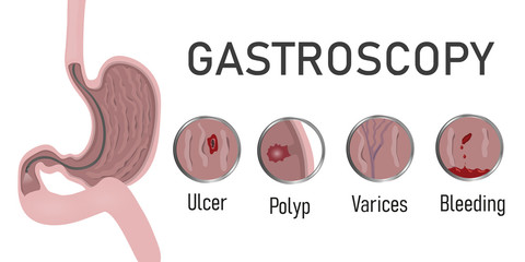Gastroscopy endoscopic procedure and indications