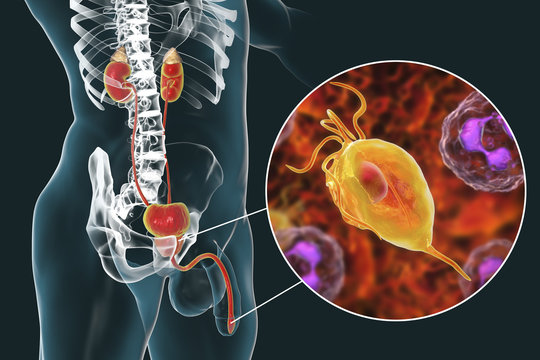 Trichomoniasis infection in man, 3D illustration showing male anatomy of genitourinary system and close-up view of Trichomonas vaginalis protozoan causing urethritis