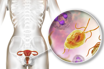 Female trichomoniasis, 3D illustration showing vaginitis and close-up view of Trichomonas vaginalis parasite