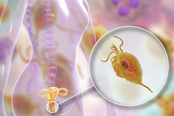 Female trichomoniasis, 3D illustration showing vaginitis and close-up view of Trichomonas vaginalis parasite