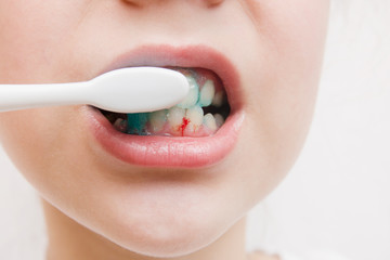 Bleeding at teeth during brushing with toothbrush.bleeding gums