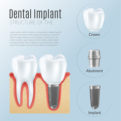 Realistic Dental Implant Infographics
