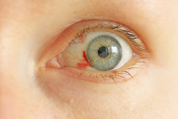 Bloodshot eye. Woman with burst blood vessel in eye. Very red bloody eyeball. Bleeding damage in...