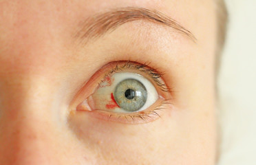 Bloodshot eye. Woman with burst blood vessel in eye. Very red bloody eyeball. Bleeding damage in...