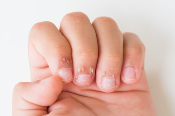 Close up child's fingers with dry skin, Eczema Dermatitis. Medicine and health care concept.