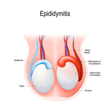 Epididymitis is inflammation of the epididymis of the testicle.