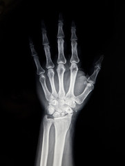 human hand x-ray