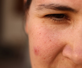 Girl with problematic skin. Acne. Girl squinting eye. 