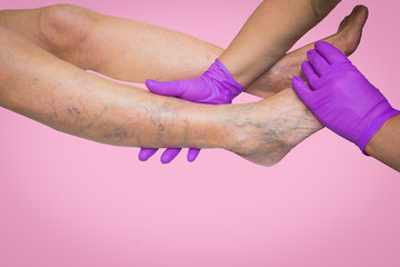 Lower limb vascular examination because suspect of venous insufficiency. The female legs on pink...