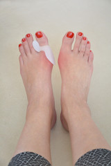 feet wearing hallux valgus orthopedic pads on thumb toes