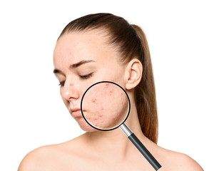 Young woman with acne problem on white background