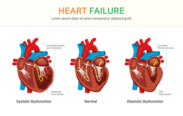 Heart failure or congestive heart failure