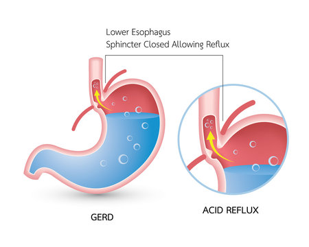 Gastroesophageal reflux disease (GERD). Acid reflux, heartburn and gerd infographic with stomach medical illustration, symptoms, causes and prevention