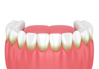 3d render of teeth with plaque and tartar