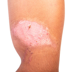 Fototapeta premium Burns hand isolated on white, skin wound. Effects of influence poison of Giant Hogweed on skin, sample. Two weeks after defeat poison of Heracleum