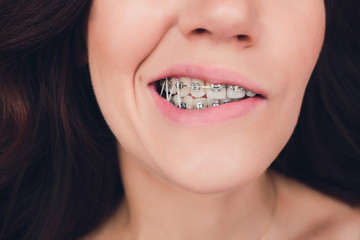 Close-up of woman wearing orthodontic elastic band