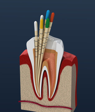 Gutta percha endodontics instrument, dental anatomy. 3D illustration