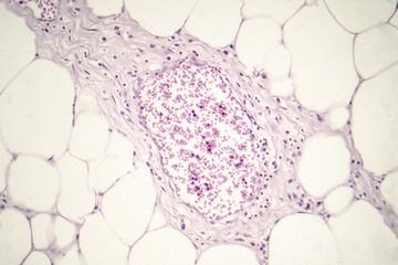 Lipoma, benign growth of fatty tissue, light micrograph, photo under microscope. Blood vessel with...