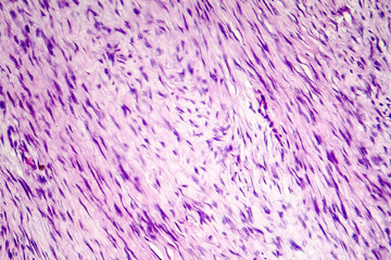 Fibroma, a benign tumour of fibrous tissue, light micrograph, photo under microscope