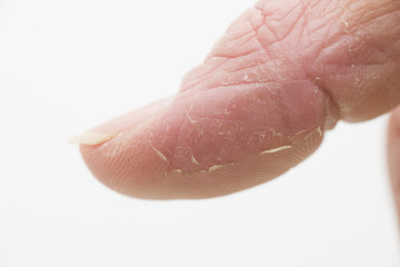 Neurodermitis, Daumen, rechts