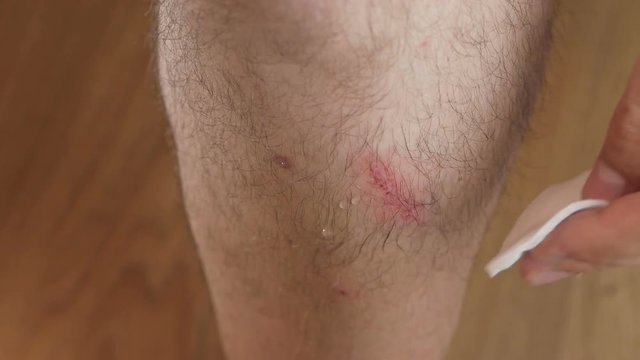 Close-up of a man's leg with an abrasion. A man treats the wound with chlorhexidine fluid from a bottle.