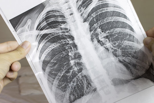 Cropped hands holding fluorography, x-ray. Lung desease concept.