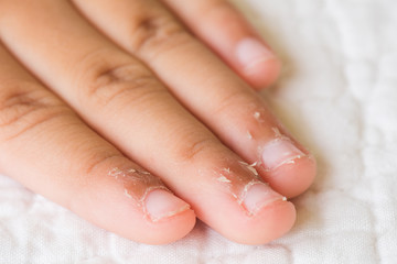 Close up child's fingers with dry skin, Eczema Dermatitis. Medicine and health care concept.