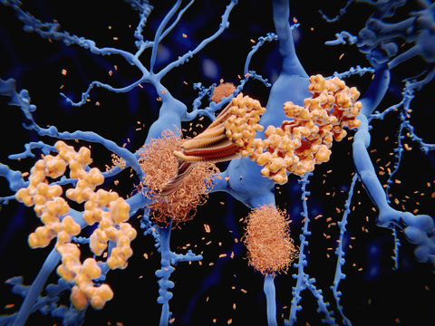 Alzheimer Krankheit: Amyloid Beta Peptide Lagern Sich Zu Amyloid-Plaques Auf Neuronen Zusammen.